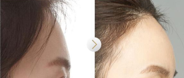 填充脂肪多少钱?