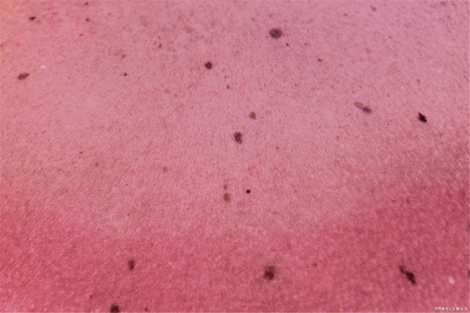 扁平疣的初期图片有吗?