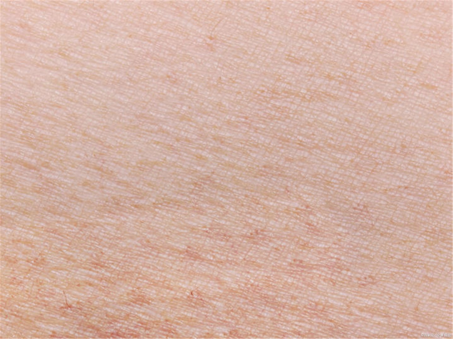 扁平疣的初期图片有吗?