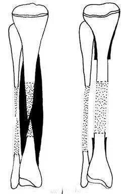 断骨增高手术是怎么回事？这种手术有科学依据吗？