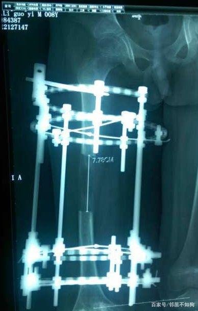 断骨增高手术是怎么回事？这种手术有科学依据吗？