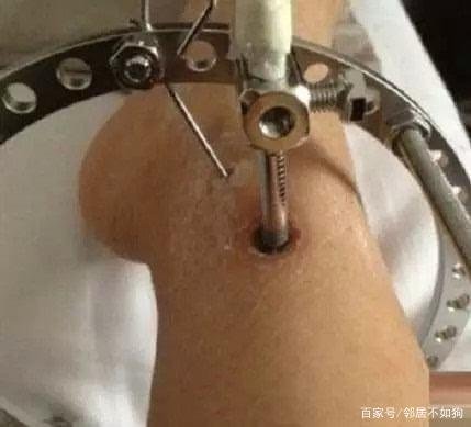 断骨增高手术是怎么回事？这种手术有科学依据吗？