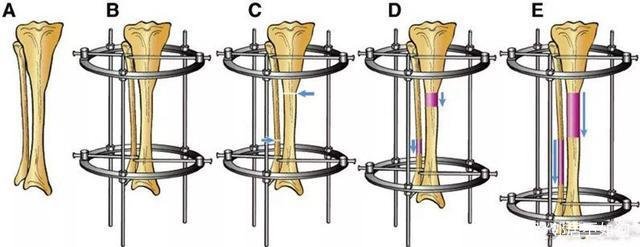 断骨增高手术是怎么回事？这种手术有科学依据吗？