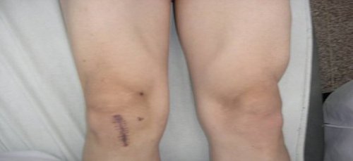 什么是肌萎缩？