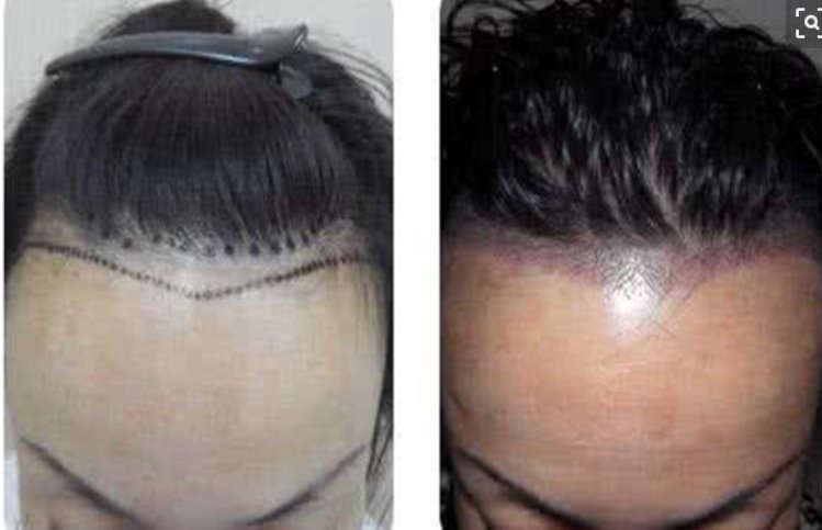 发际线移植手术有哪些步骤？