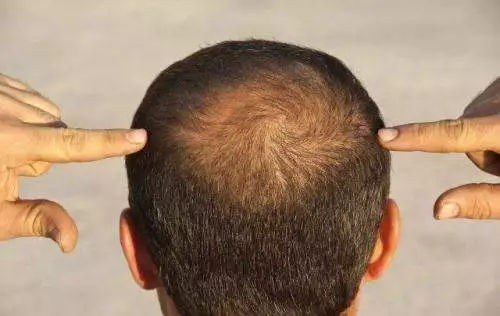 毛发种植好不好