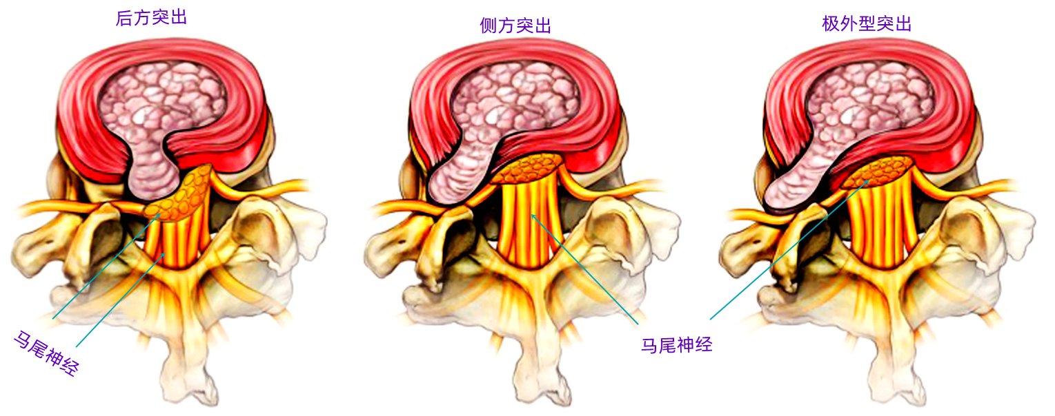 请问治疗腰椎间盘突出有什么方法最好