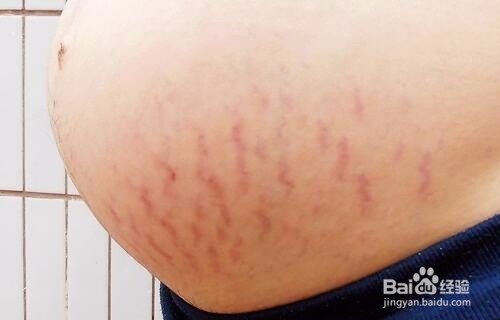 妊辰纹长什么样图片