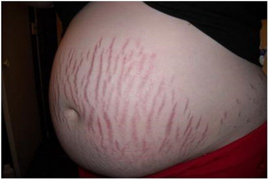 妊辰纹长什么样图片