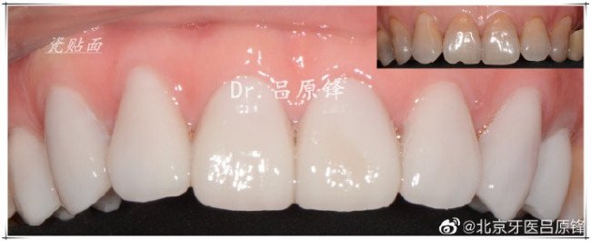 牙齿贴片是什么有什么作用
