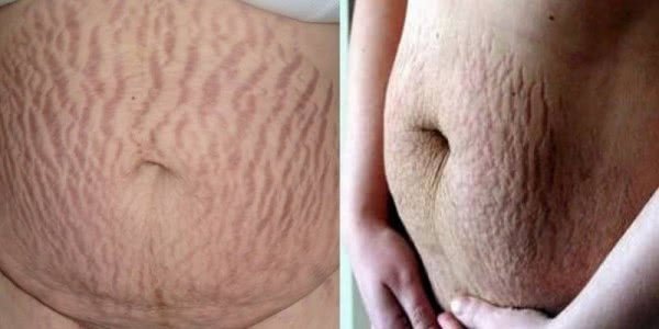 妊辰纹长什么样图片