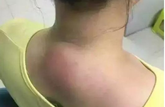 富贵包怎么消除最有效的方法是什么？