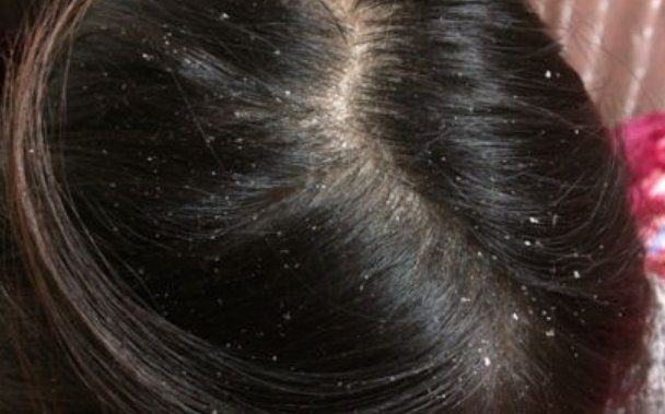 头皮是怎么产生的