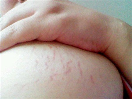 妊辰纹长什么样图片