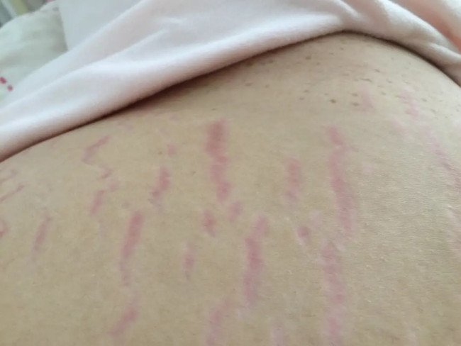 妊辰纹长什么样图片