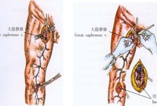 pratt，perthes，trendelenburg是什么医学实验