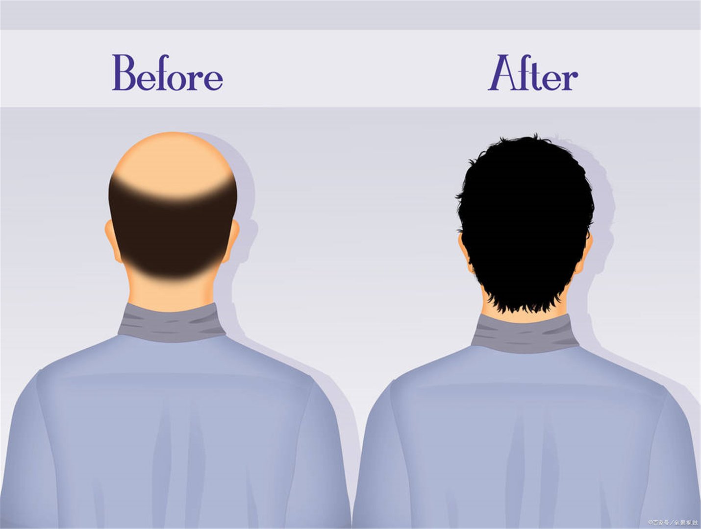 请问脱发用什么洗发水比较好？