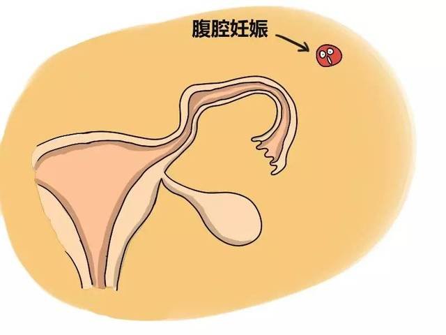 腹腔妊娠是一种比较少见的以为妊娠,具体是什么意思?