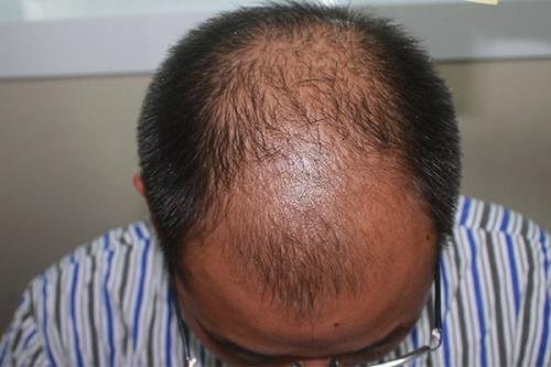 章光101效果怎么样多久见效?