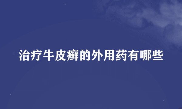 治疗牛皮癣的外用药有哪些