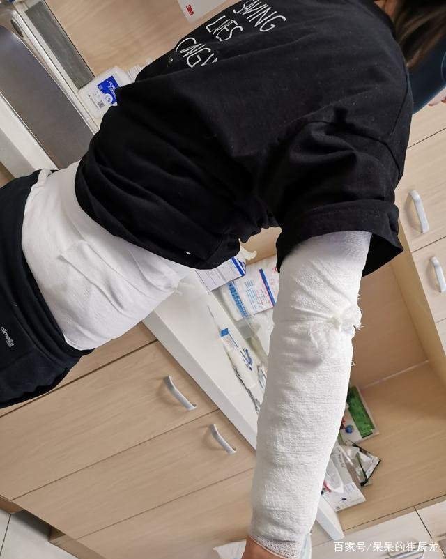 知名女星邓莎拔罐意外着火，后背遭大面积烧伤，是什么原因导致的意外？