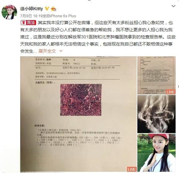 90后女演员徐婷患淋巴癌去世 北漂5年为父母还债买房