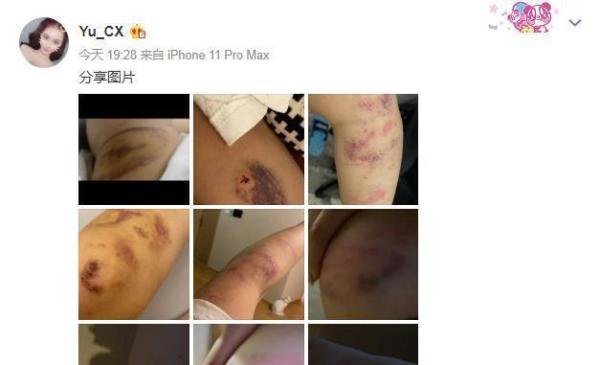 死亡宣告又打人了！女友晒出被打照片，网友看了直呼打的也太狠了