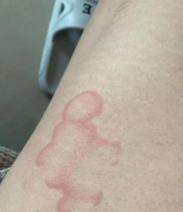 荨麻疹到底是身体哪里出问题?给你一种草药就可以解决——摆不折秧