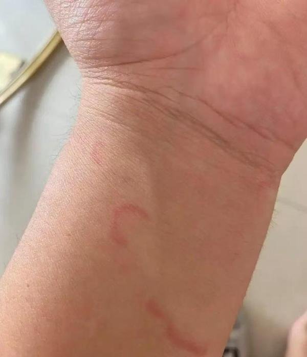 荨麻疹到底是身体哪里出问题？给你一种草药就可以解决——摆不折秧