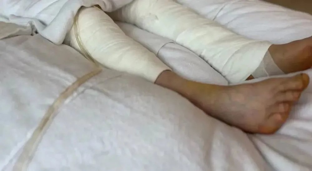 陕西西安大爷杀猪被猪一脚蹬进开水盆，造成了什么样的后果？