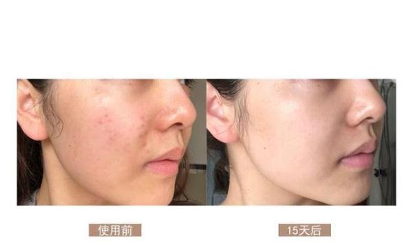 鲜活细胞种植 | 年轻5-10岁,冻龄3-5年
