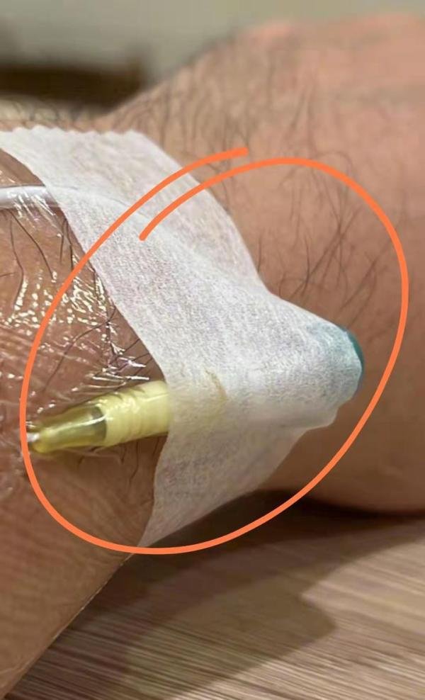 周杰伦身体不适就医，手腕插针急诊照片曝光，手麻疑似心脏出问题